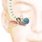 How-it-works_Cochlear-Baha-5_Connect_SSD